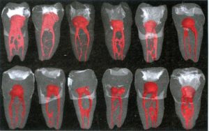 Picture of various teeth, showing the complexity of root canal systems. Picture of various teeth, showing the complexity of root canal systems.