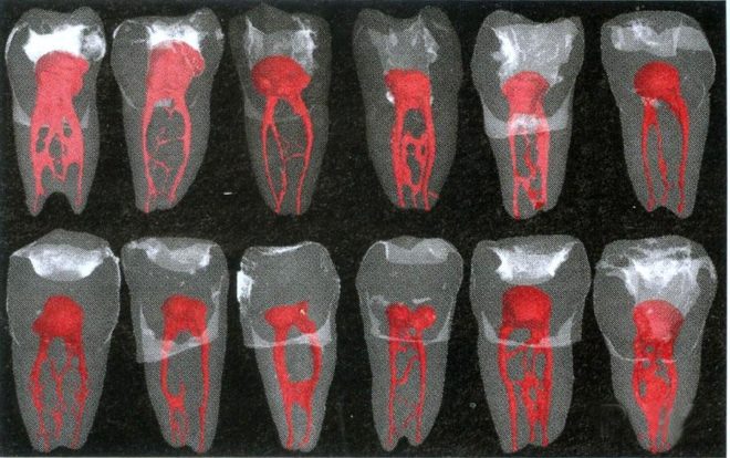 What You Need To Know About Root Canals And Cancer Science