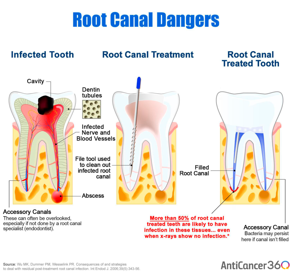 Tooth Diagram Root Canal at Laura Peacock blog